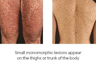 Illustration of small monomorphic lesions appear on the thighs or trunk of the body