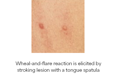 Illustration of wheal-and-flare reaction is elicited by stroking lesion with a tongue spatula